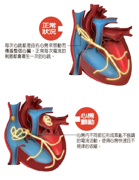 靠飲食預防心律不整 心律不整