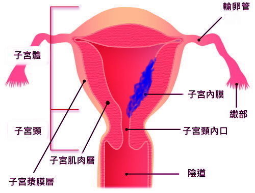 聰明吃,不讓子宮內膜癌成女性夢饜 子宮內膜癌